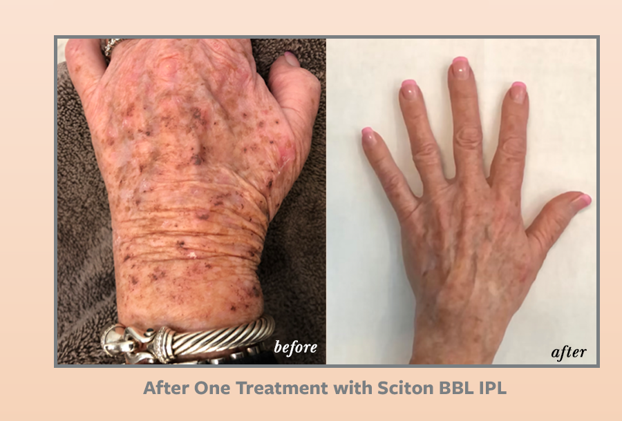 woman hand wrinkles before and after Sciton BBL IPL treatment | Melindas Med-Spa & Salon in North Myrtle Beach SC