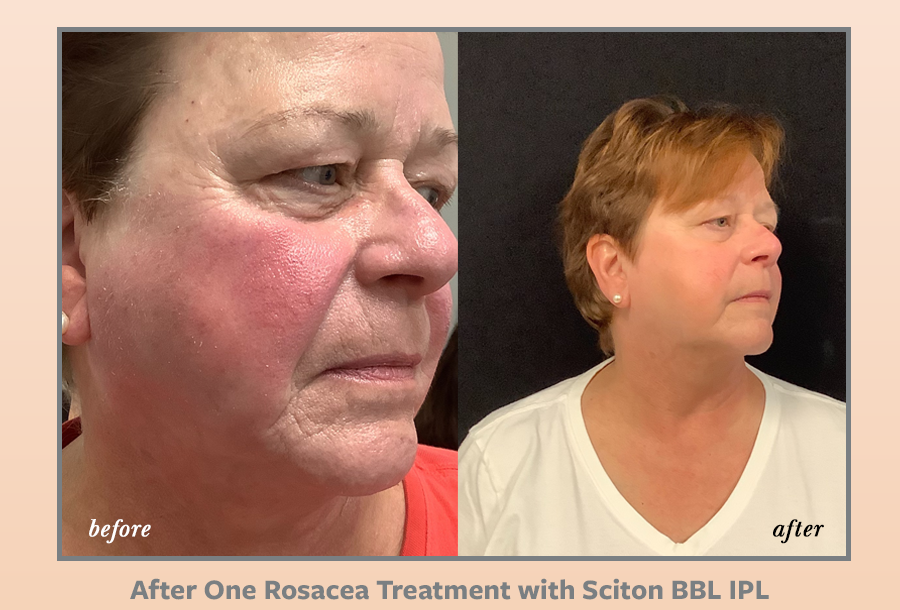 woman face wrinkles before and after Sciton BBL IPL Rosacea treatment | Melindas Med-Spa & Salon in North Myrtle Beach SC