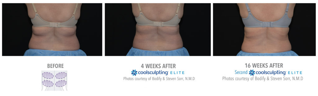 Coolsculpting Treatment Results on Bra Line Female | Melindas Medical Spa & Salon in North Myrtle Beach, SC