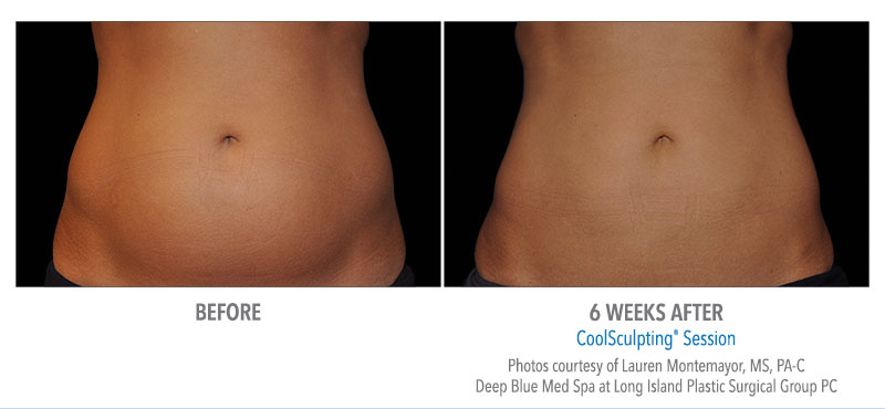 Before and After Coolsculpting Treatment result of Female | Melindas Medical Spa & Salon in North Myrtle Beach, SC