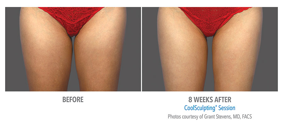 Before and After Coolsculpting Treatment Results on Female Inner Thigh | Melindas Medical Spa & Salon in North Myrtle Beach, SC
