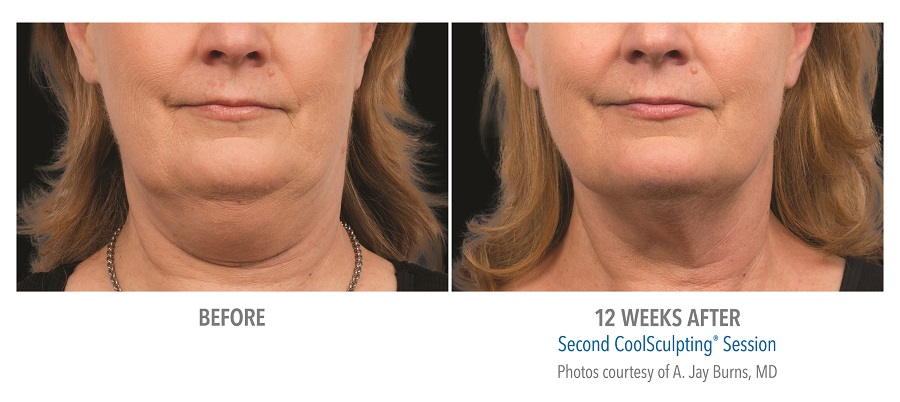 Before and After Coolsculpting Treatment Results on Female Submentum | Melindas Medical Spa & Salon in North Myrtle Beach, SC
