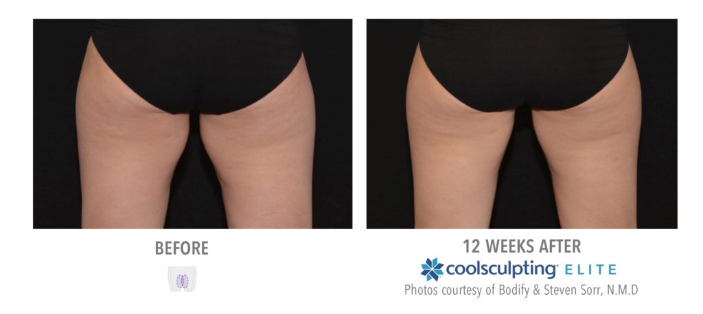 Before and After Coolsculpting Treatment Results on Female Inner Thigh | Melindas Medical Spa & Salon in North Myrtle Beach, SC