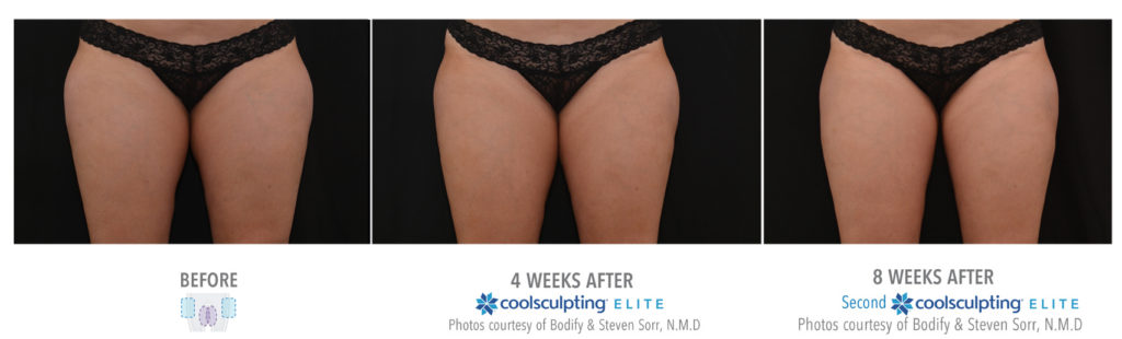 Coolsculpting Treatment Results on Female Inner and Outer Thigh | Melindas Medical Spa & Salon in North Myrtle Beach, SC