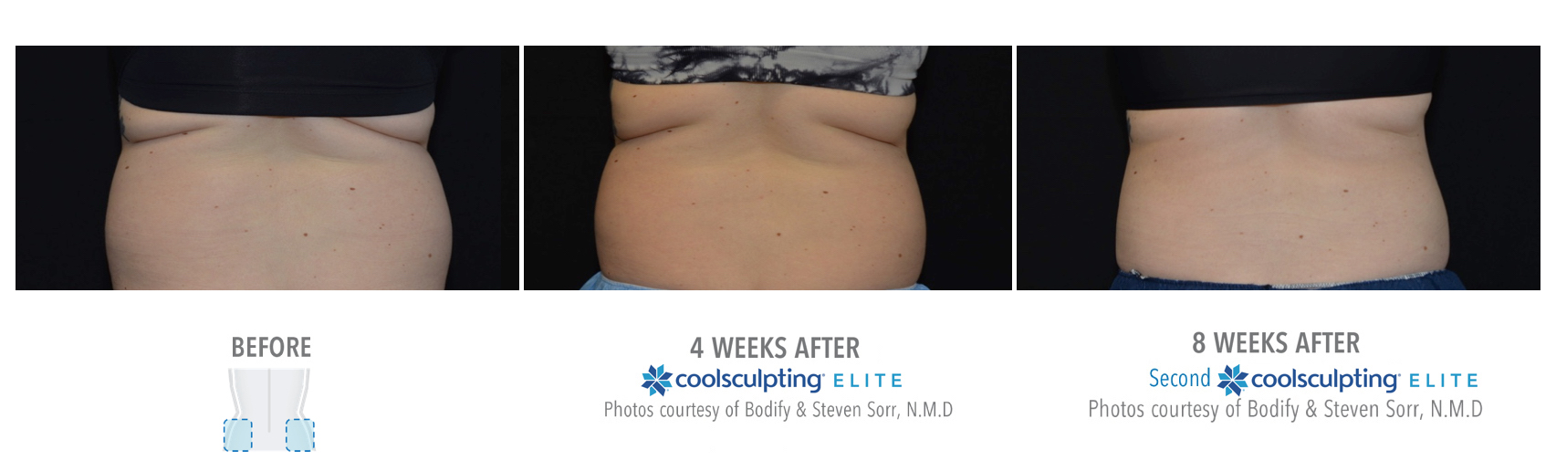 Coolsculpting Treatment Results on a Female Love Handles | Melindas Medical Spa & Salon in North Myrtle Beach, SC