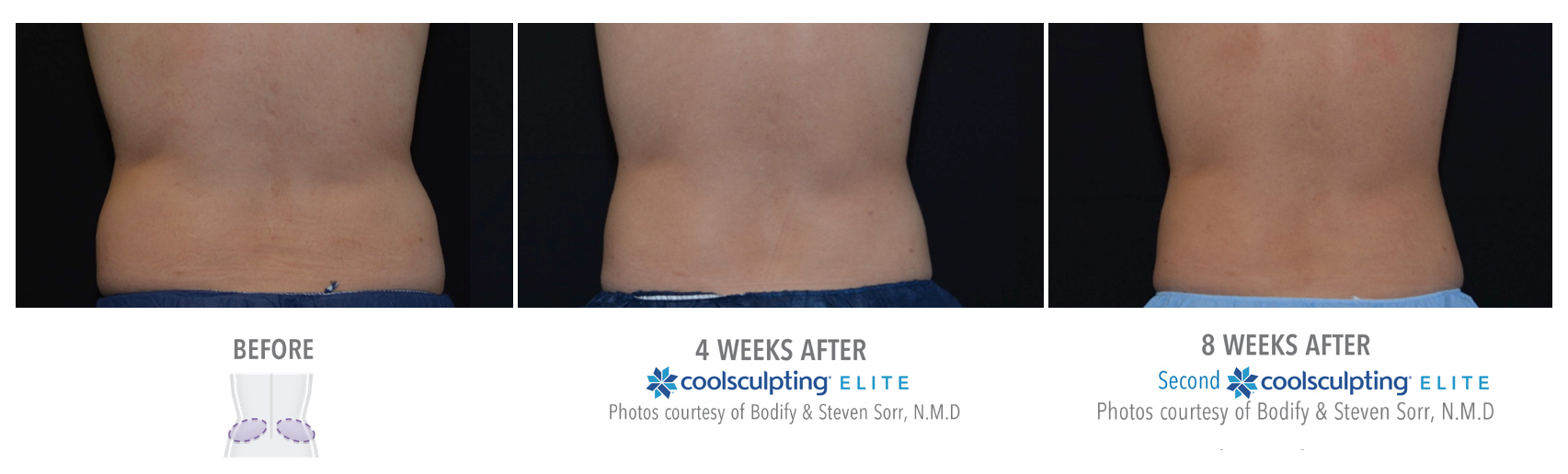 Coolsculpting Treatment Results on a Male Love Handles | Melindas Med-Spa & Salon in North Myrtle Beach SC