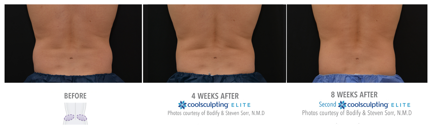 Coolsculpting Treatment Results on a Male Love Handles | Melindas Med-Spa & Salon in North Myrtle Beach SC