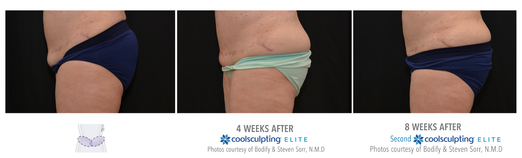 Coolsculpting Treatment Results on a Female Lower Abs | Melindas Medical Spa & Salon in North Myrtle Beach, SC