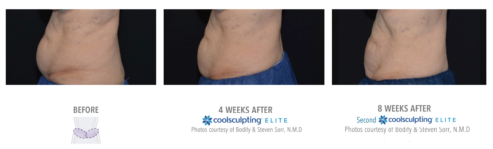 Coolsculpting Treatment Results on Lower abs Female | Melindas Medical Spa & Salon in North Myrtle Beach, SC