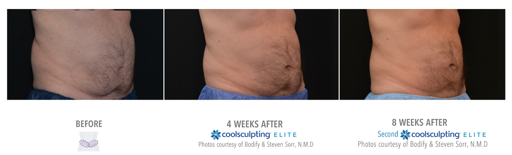 Coolsculpting Treatment results of a male | Melindas Medical Spa & Salon in North Myrtle Beach, SC