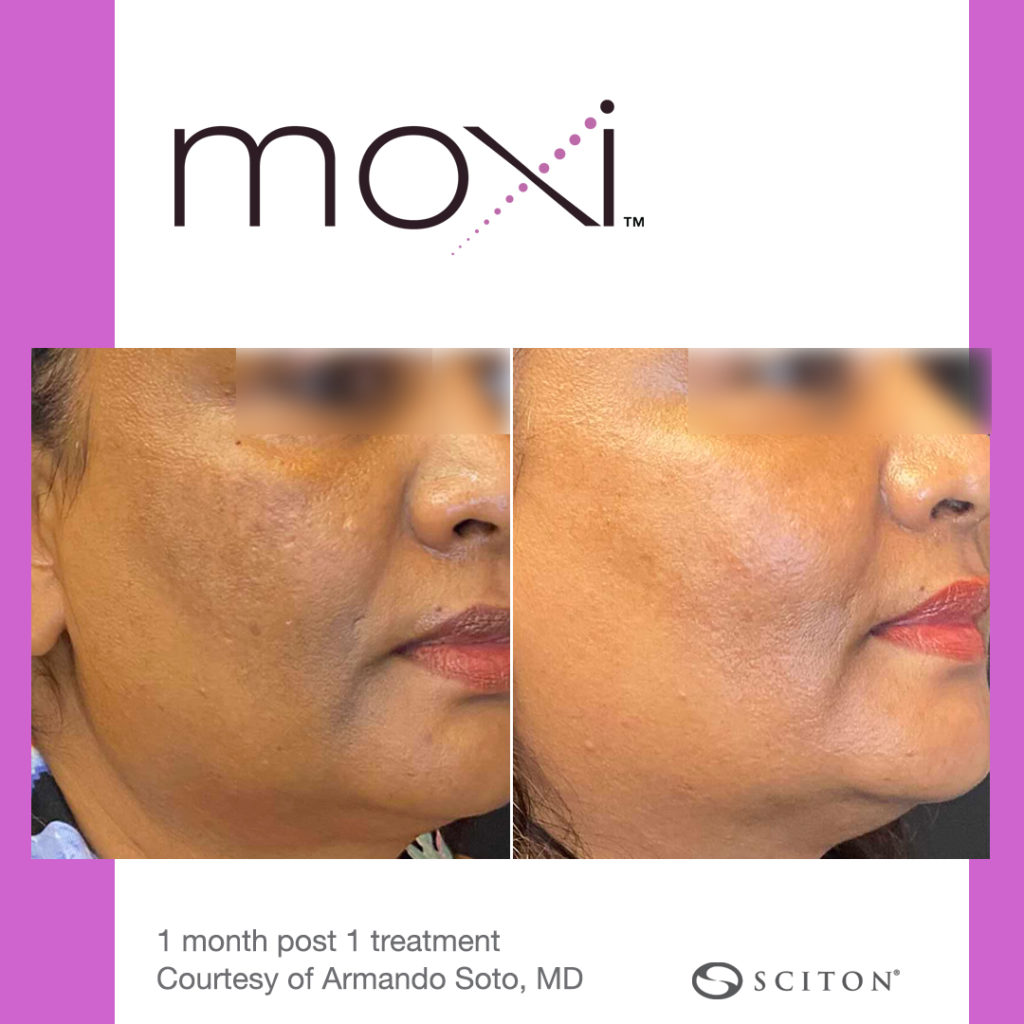 Before and After Moxi Treatment Results on Female face | Melindas Med-Spa & Salon in North Myrtle Beach SC