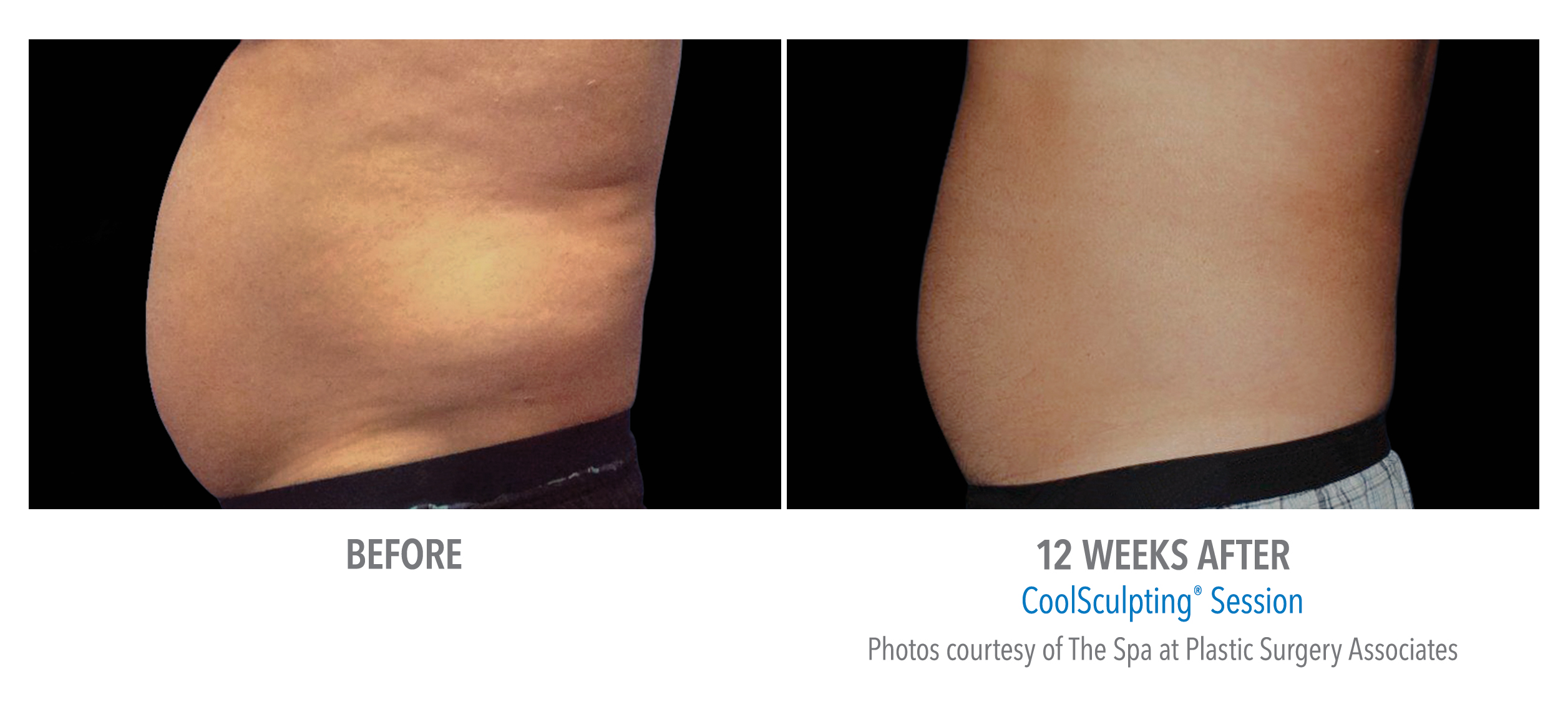 Before and After Coolsculpting Treatment result of a male | Melindas Medical Spa & Salon in North Myrtle Beach, SC