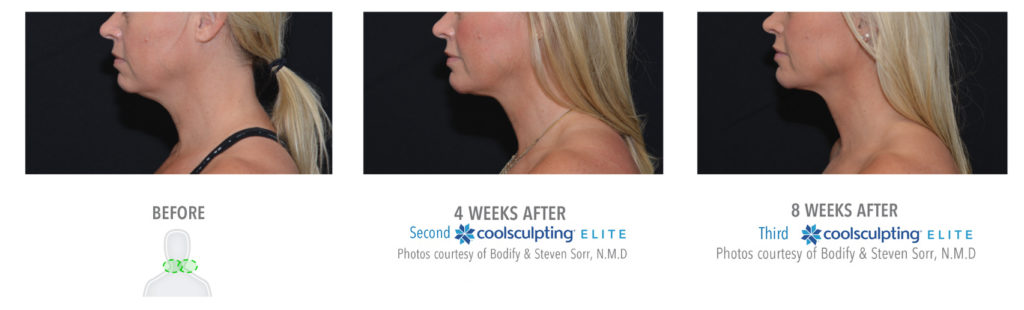 Coolsculpting Treatment Results on Female Submentum | Melindas Medical Spa & Salon in North Myrtle Beach, SC