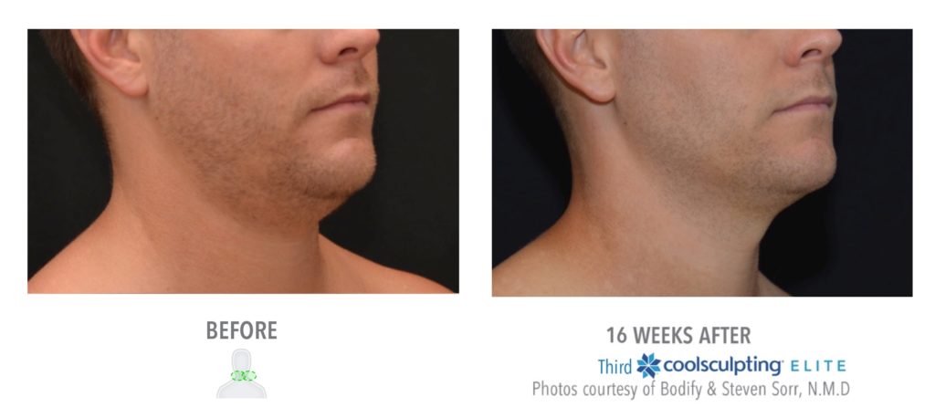 Before and After Coolsculpting Treatment Results on Male Submentum | Melindas Medical Spa & Salon in North Myrtle Beach, SC