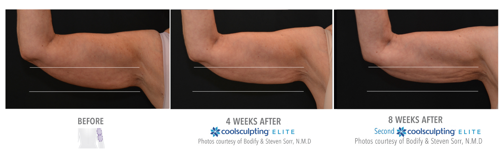 Coolsculpting Elite Treatment Results Before and After on a Female Upper Arms | Melindas Medical Spa & Salon in North Myrtle Beach, SC