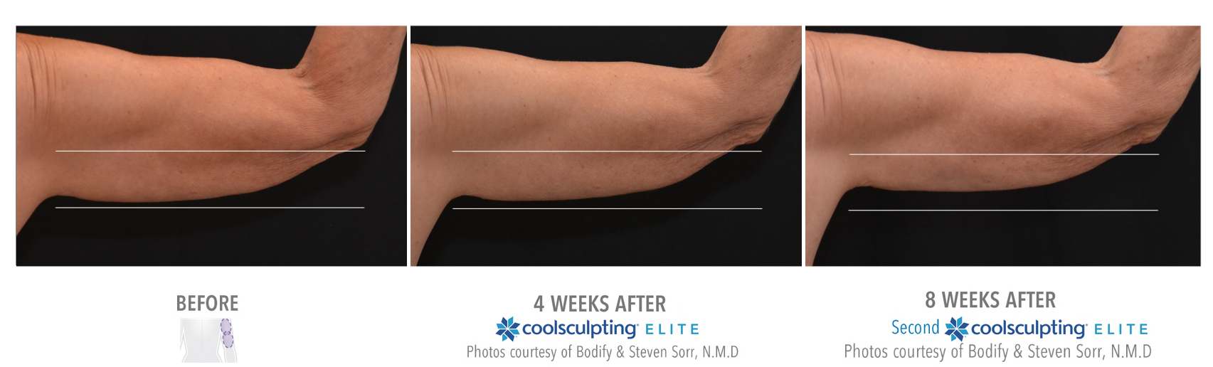 Coolsculpting Elite Treatment Results Before and After on a Female Upper Arms | Melindas Medical Spa & Salon in North Myrtle Beach, SC