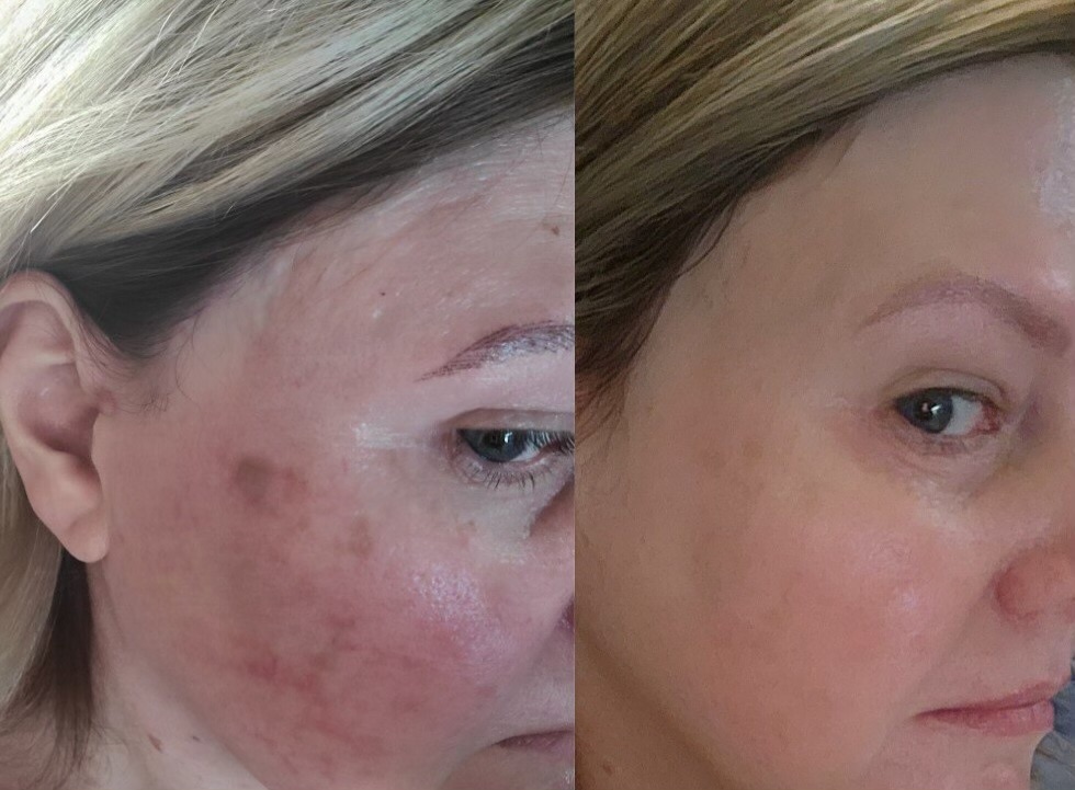 Young Female Getting bbl moxi laser treatment before and after | Melindas Med-Spa & Salon in North Myrtle Beach SC