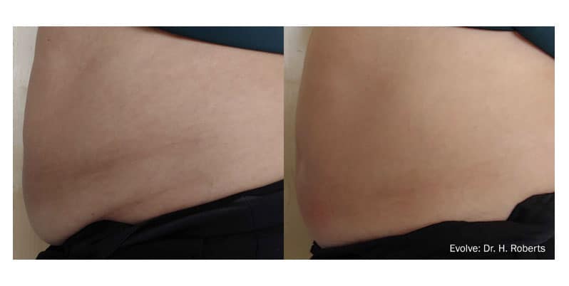 Before and After Evolve Tite Treatment result of Female | Melindas Medical Spa & Salon in North Myrtle Beach SC