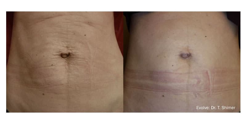 Before and After Coolsculpting Treatment result of Female | Melindas Medical Spa & Salon in North Myrtle Beach SC