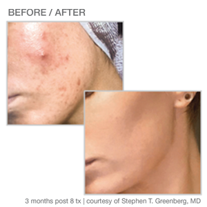 Woman cheek before and after Sciton BBL IPL treatment | Melindas Med-Spa & Salon in North Myrtle Beach SC