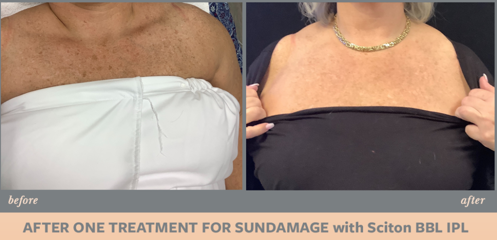 woman shoulder and chest before and after Sciton BBL IPL Sundamage treatment | Melindas Med-Spa & Salon in North Myrtle Beach SC