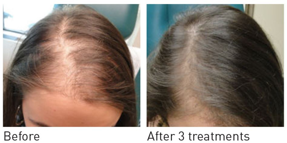 Female Hair Restoration Before & After Treatment | Melindas Med Spa & Salon in North Myrtle Beach, SC