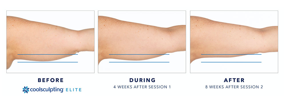 Coolsculpting Upper Arms Female Before & After Photos | Melindas Med Spa & Salon in North Myrtle Beach, SC