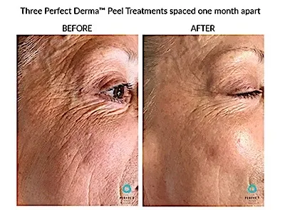 Before and After Perfect Peel (2)