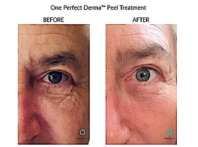 Before and After Perfect Peel (3)