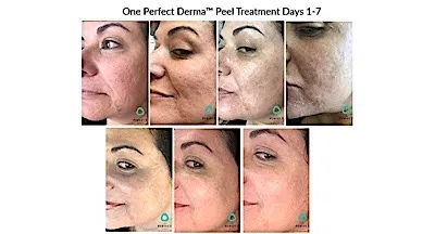 Before and After Perfect Peel