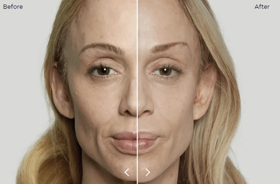 Before and After Sculptra