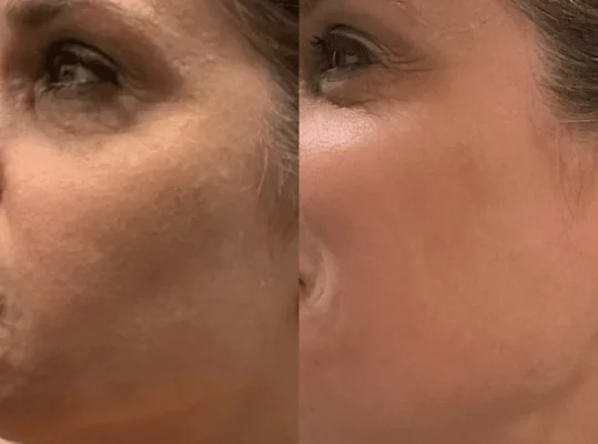 Before and After Skinvive (2)